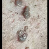 درمان ریشه ای زگیل تناسلی و تبخال