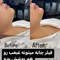 کلینیک لیزرمو بوتاکس تزریق  ژل لب روسی فیلر لیفت|خدمات آرایشگری و زیبایی|تهران, صادقیه|دیوار