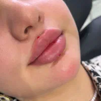 خدمات فیلروبوتاکس