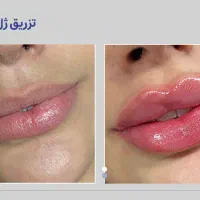 جشنواره تخفیفات جراحی بینی،لیفت،بوتاکس،مزو|خدمات آرایشگری و زیبایی|کرج, مهرویلا جنوبی|دیوار