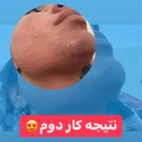 لیزر موهای زائد با هدیه یه عدد عطر