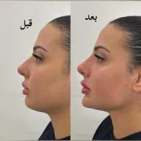 تزریق فیلر بوتاکس،نخ لیفتینگ بانصف قیمت بازار|خدمات آرایشگری و زیبایی|کرمانشاه, |دیوار