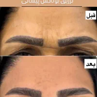 خدمات زیبایی توسط متخصص بلفارو بوتاکس لیفت زاویه|خدمات آرایشگری و زیبایی|اصفهان, گلزار|دیوار