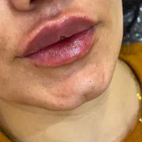 ژل و بوتاکس ‌‌پاکسازی|خدمات آرایشگری و زیبایی|مشهد, شهید معقول|دیوار