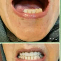 تعویض دندان مصنوعی قدیمی با دندان مصنوعی نو|آرایشی، بهداشتی، درمانی|شهرکرد, |دیوار