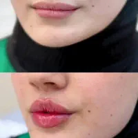 تزریق و اموزش ژل و بوتاکس|خدمات آرایشگری و زیبایی|کرمانشاه, |دیوار