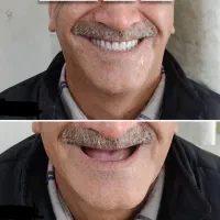 دندان مصنوعی