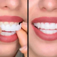 لمینت متحرک دندان