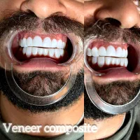 خدمات کامپوزیت دندان با اقساط آسان|خدمات آرایشگری و زیبایی|قم, صفائیه|دیوار