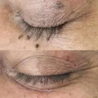 برداشتن خال.زگیل تناسلی.جای زخم و بخیه. میخچه