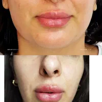 زاویه فک به سبک طبیعی