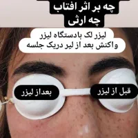 لیزر موهای زائد.کلینیک زیبایی آیسان اندیشه فاز 1