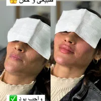 ژل و فیلر صورت و بدن|خدمات آرایشگری و زیبایی|اصفهان, ملک|دیوار