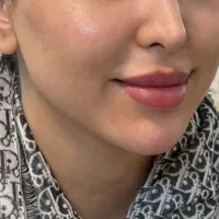 جشنواره عیدانه بوتاکس و ژل با قیمت تکرار نشدنی