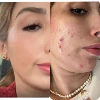 با کمترین قیمت پوستتو خوب کن (تخفیف تا اخر ماه)
