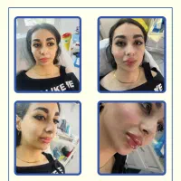 فیلر لب روسی -زاویه سازی -بوتاکس-پی ار پی -مزو|خدمات آرایشگری و زیبایی|تهران, دریا|دیوار