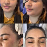 درمان مشکلات پوستی با لیزر co2 فرکشنال