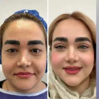 ۵۰%تخفیف بلفارو کاشت ابرو چالگونه در کلینیک
