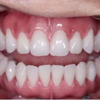 دندان مصنوعی بدون لقی تضمینی