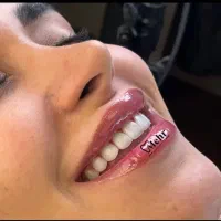 جشنواره کامپوزیت دندان بیلیچینگ