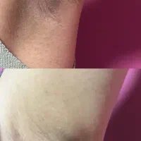 لیزر موهای زائد فقط ۵۹۰ تومن، رفع تیرگی، ریموو تتو