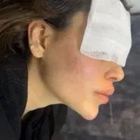 فیلر لب ویژع یلدا فقط 650