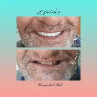 دندانسازی/دست دندان متحرک/سپیدان/هماشهر/همایجان|خدمات آرایشگری و زیبایی|شیراز, گویم|دیوار