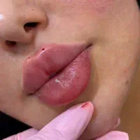 تخفیف خدمات تزریق ژل و بوتاکس و آموزش تخصصی