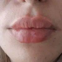 اموزش ژل بوتاکس و تمام خدمات مزو تراپی|خدمات آموزشی|مشهد, چهارچشمه|دیوار