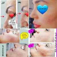 آموزش وارائه خدمات ژل و بوتاکس و فیلربادی(ژل بدن)|خدمات آرایشگری و زیبایی|جهرم, |دیوار