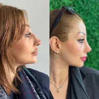 عمل بینی فقط ۲۰ تومن (تعداد محدود)
