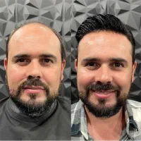 کاشت مو و ابرو اقساطی حتی با سفته