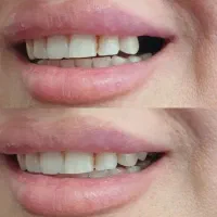 دندانسازی ( تحویل یک روزه )|خدمات زیبایی و سلامت|اصفهان, برزان|دیوار