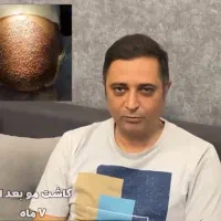 کاشت مو با تراکم بالا فقط با ۸ میلیون پیش‌پرداخت|خدمات آرایشگری و زیبایی|تهران, جردن|دیوار