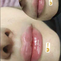 تزریق ژل و بوتاکس