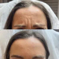 خدمات زیبایی ژل بوتاکس و پی آر پی مزوتراپی....