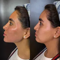 مدل روسی هایفو نخ کلینیک پوست بدون رقیب واقعی|خدمات آرایشگری و زیبایی|تهران, زعفرانیه|دیوار