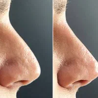 بینیت رو بدون جراحی لیفت کن