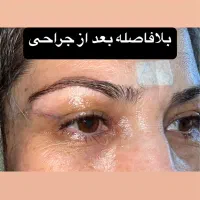 بلفاروپلاستی پلک با روش لیزری بدون رد بخیه|خدمات آرایشگری و زیبایی|تهران, پاسداران|دیوار