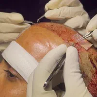 مدل کاشت مو و ابرو|خدمات آرایشگری و زیبایی|تهران, نارمک|دیوار