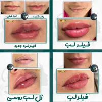 تزریق تخصصی بوتاکس صورت توسط پزشک، مطب زیبایی رشت|خدمات آرایشگری و زیبایی|رشت, گلسار|دیوار