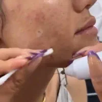لیزر خال، خال گوشتی خال پیله منگوله پاکسازی درمانی|خدمات آرایشگری و زیبایی|هشتگرد, هشتگرد قدیم|دیوار