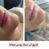 ژل و بوتاکس با شرایط اقساطی|خدمات آرایشگری و زیبایی|اهواز, گلستان|دیوار