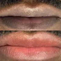 از بین بردن کبودی و تیرگی لب
