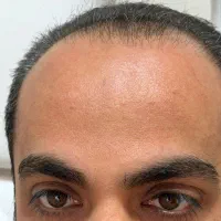 تخفیف باور نکردی فیلر و بوتاکس