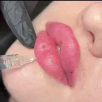 تزریق چربی صورت وبدن و تزریق فیلر۸۰۰ هزار