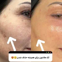 خروج لک و کک مک جای جوش با درمان تلفیقی|خدمات آرایشگری و زیبایی|سبزوار, کاشفی شمالی (دادگستری)|دیوار