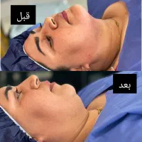 تخفیف ویژه حذف غبغب،فرم‌دهی صورت بدون جراحی سنگین