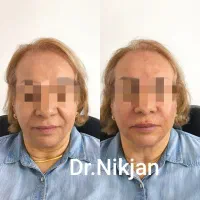 فیلر/بوتاکس/لب روسی/جوانساز/مزوژل مطب دکتر نیک جان|خدمات آرایشگری و زیبایی|رشت, گلسار|دیوار
