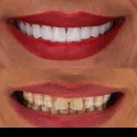 افر ویژه کامپوزیت دندان مواد تضمینی و اصلی|خدمات آرایشگری و زیبایی|کرج, گوهردشت|دیوار